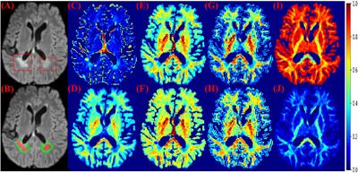 GAMER-MRI in Multiple Sclerosis Identifies the Diffusion-Based Microstructural Measures That Are Most Sensitive to Focal Damage: A Deep-Learning-Based Analysis and Clinico-Biological Validation